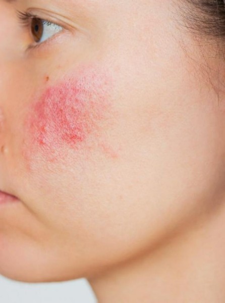 Traitement vasculaire