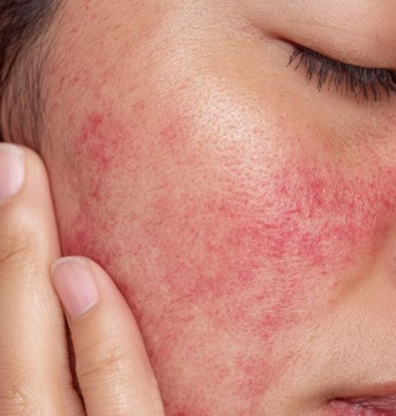 Traitement vasculaire